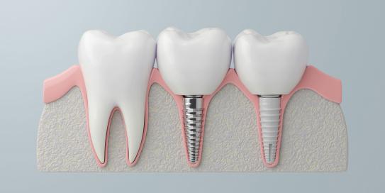 Implantate: Die Stabile Lösung